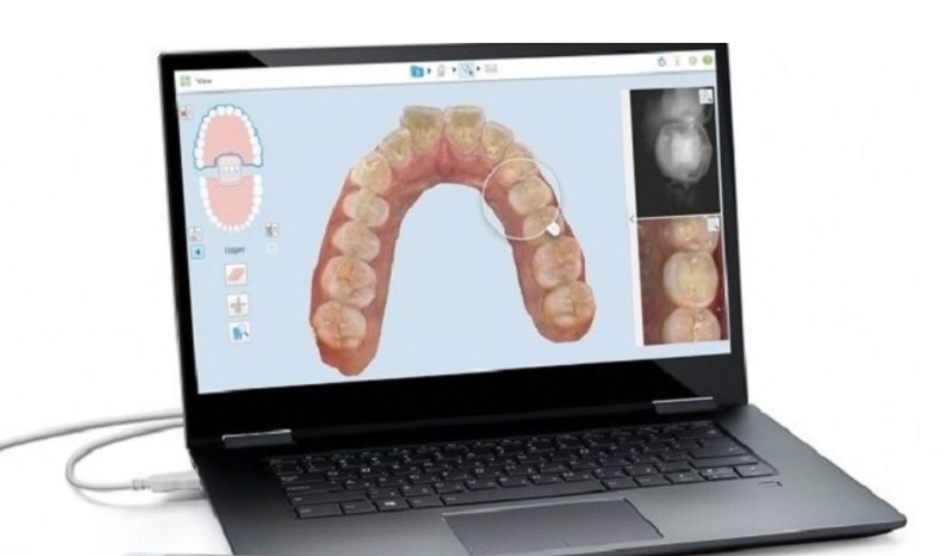 Hình ảnh scan răng 3D